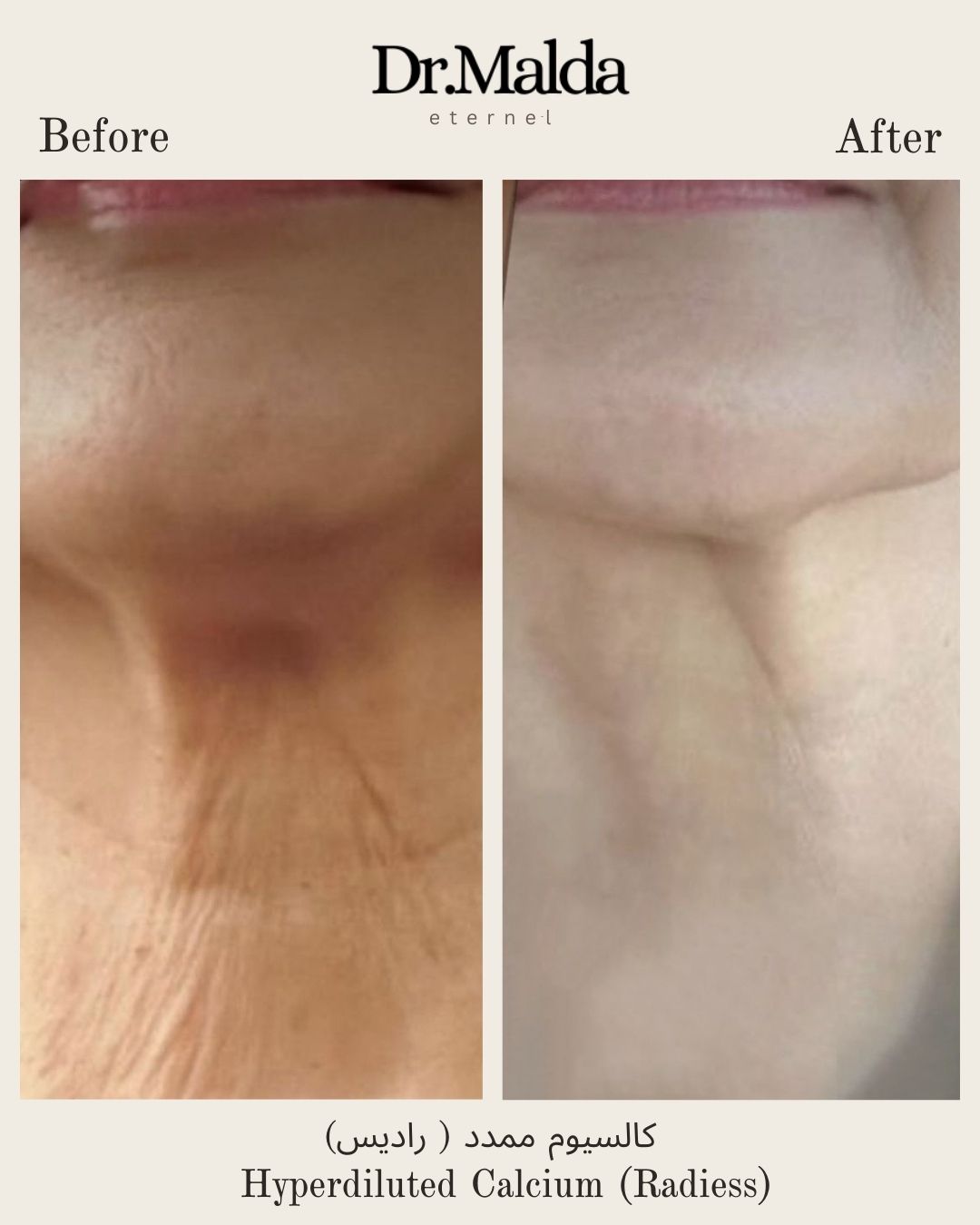 Neck hyperdiluted calcium(1)
