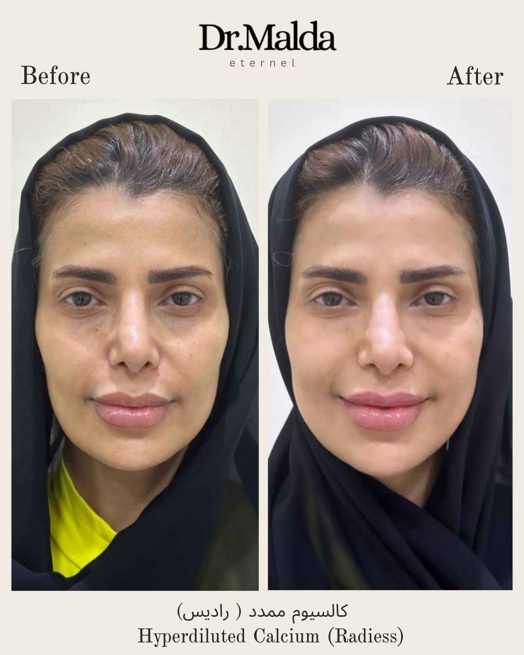 Face-hyperdiluted-calcium_11zon