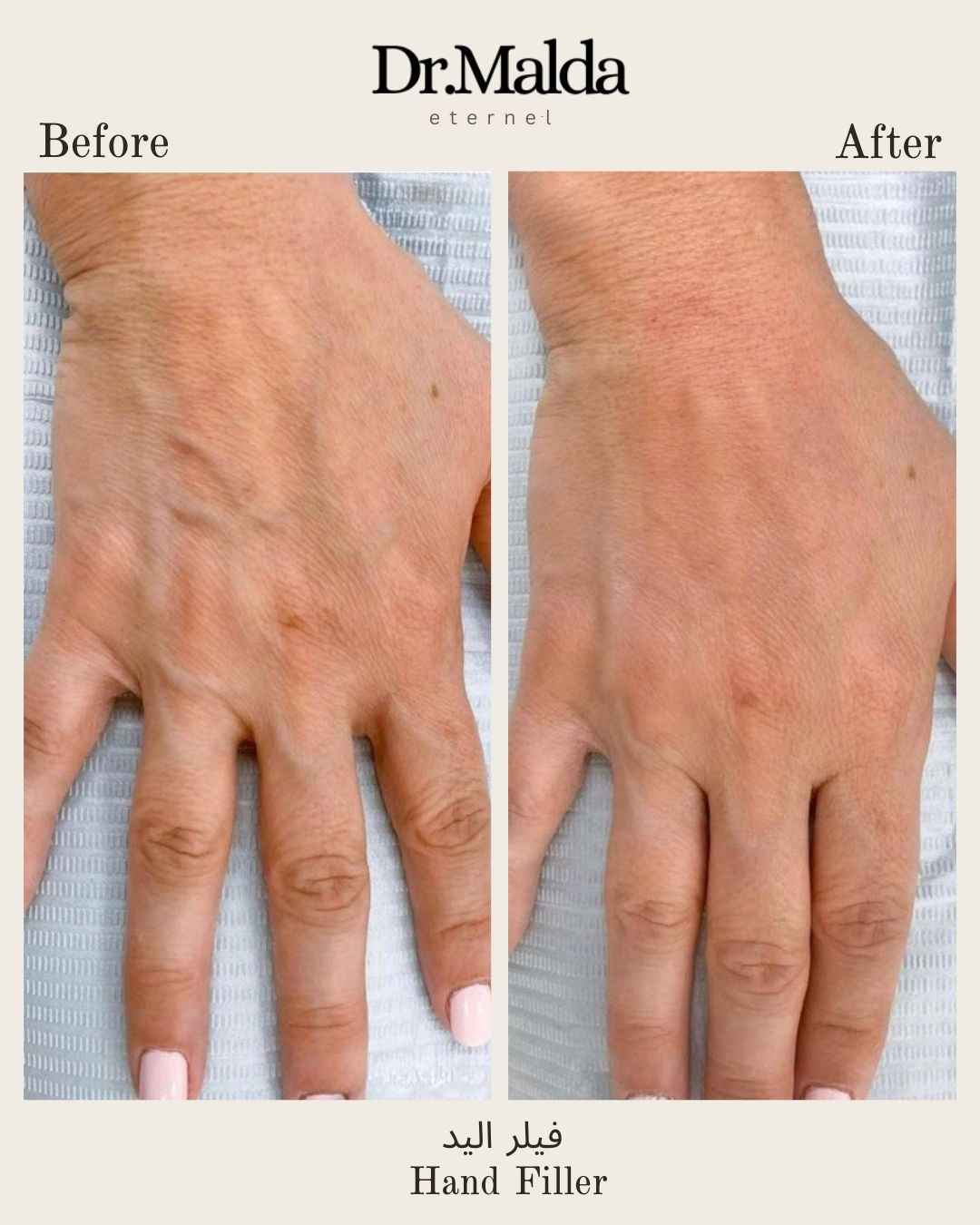 Hands-filler1_11zon