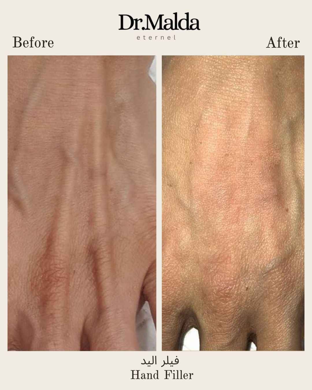 Hands-filler_11zon