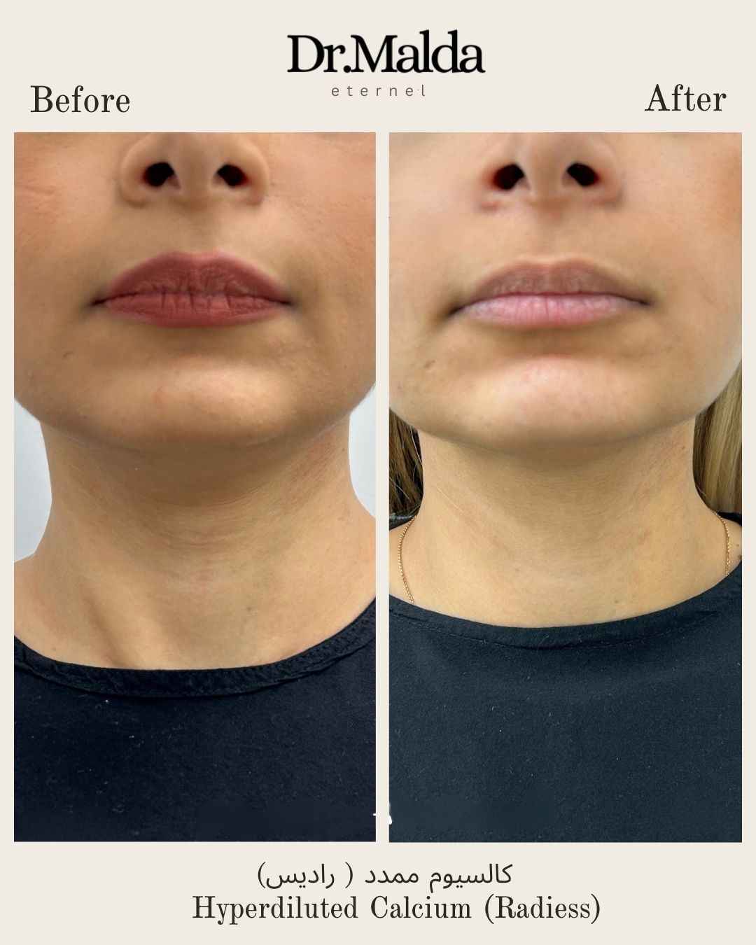 Neck-hyperdiluted-calcium_11zon