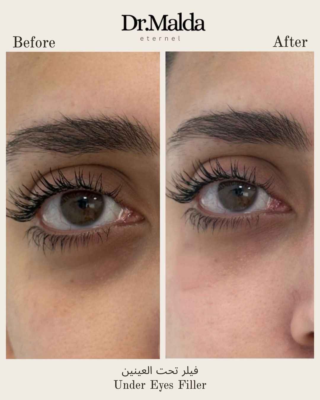 Under-eyes-filelrs_11zon